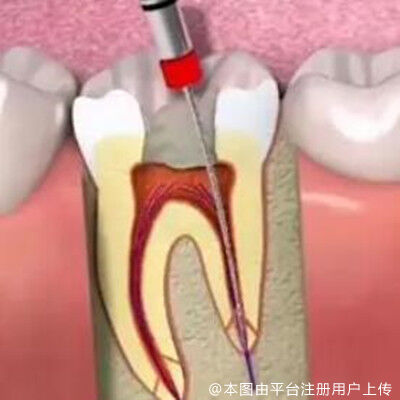 根管治疗