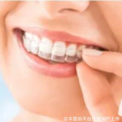 【牙齿科普】关于牙齿矫正的一些“坦白局”，你是不是也被“骗”过？