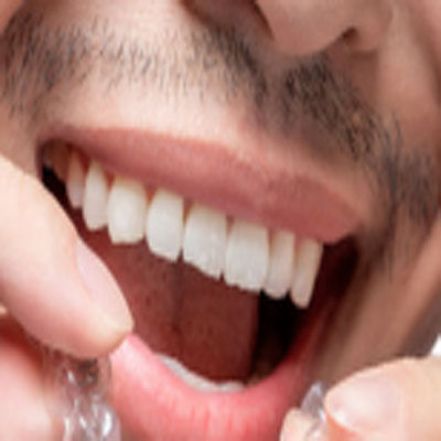 为什么有人说暑期是牙齿矫正的好时机？矫正手术时间和矫正周期需要多久？