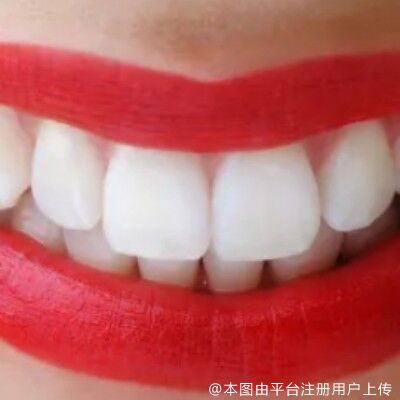 烤瓷牙热聊话题盘点，想知道能不能做烤瓷牙的看过来！