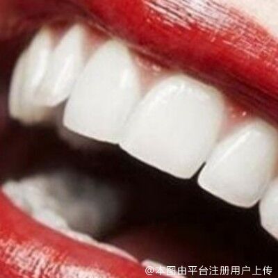 关于牙齿矫正的“黄金期”？抓好时间“美颜”不是问题！