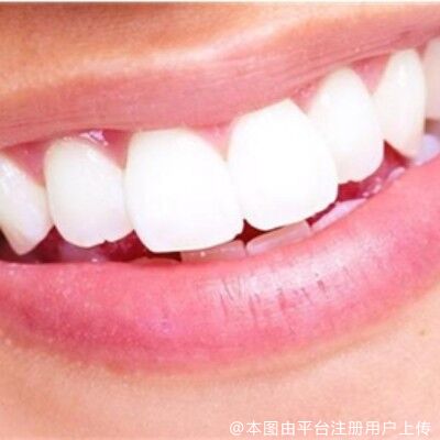 如果你的牙齿出现这些情况要注意了！你可能需要做矫正了！