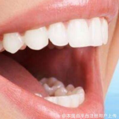 总觉得牙齿矫正太“可怕”不敢去？帮你整理正畸全过程！