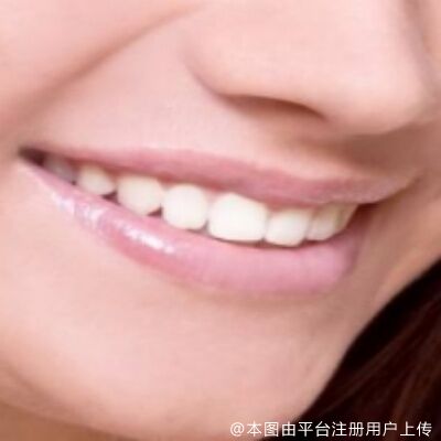 洗完牙可以做冷光美白吗？做完冷光美白忌口多久？