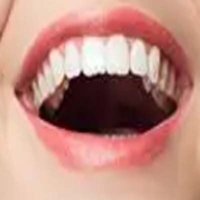 牙周深度SPA后牙缝“变大”？背后真相大揭秘