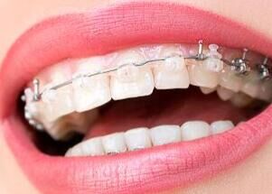 2025年牙齿矫正新趋势：AI方案设计、机器人辅助粘接精准度提升