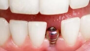 老龄化加速：2030年种植牙需求将达4000万颗，市场缺口有多大？