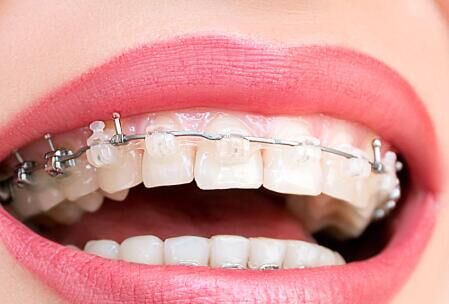 儿童早期矫正市场爆发：2025年渗透率或达35%的深层逻辑