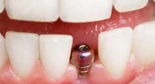 2030年种植牙市场预测：老龄化+消费升级下的千亿赛道