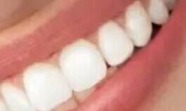 烤瓷牙“寿命有限”?揭秘修复