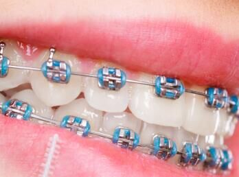 矫正牙齿能医保报销吗？这些省钱技巧帮你省下半年工资！