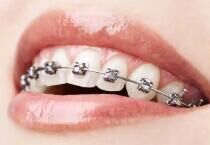 儿童矫正黄金期：7-12岁早期干预，省时省力省钱！