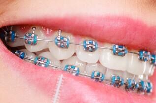 牙齿矫正全流程：从面诊、戴牙套到保持器，每一步都不踩坑