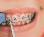 牙齿矫正费用全攻略：从检查到摘牙套，哪些钱必须花？