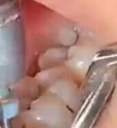 反复牙疼、牙龈红肿？根管治疗一次性解决根源问题