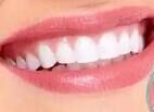 种植牙能用多久？正规种植+正确护理，寿命可达20年+