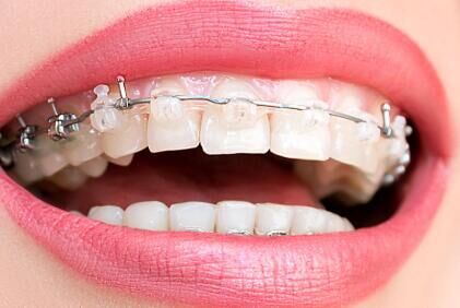 牙缝大、牙齿稀疏？针对性矫正方案，让牙齿紧密排列