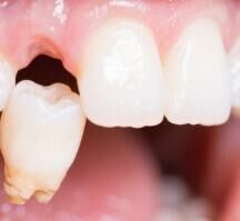 种植牙技术大揭秘：如何实现缺牙的高效、精准修复