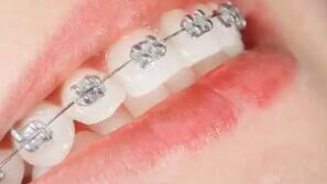牙齿矫正的“隐形成本”：这些费用你可能没考虑到！