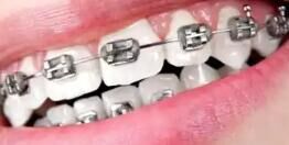 孕妇/老年人牙齿矫正：特殊人群的注意事项与方案