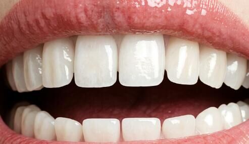 四环素牙、氟斑牙自卑？烤瓷牙美白修复，笑出自信光芒