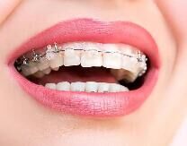 成人牙齿矫正有必要吗？整牙真的能改变侧颜吗？