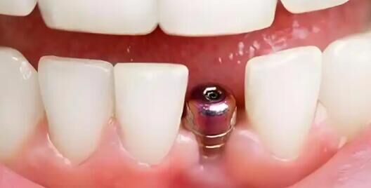 老人缺牙难进食？微创种植牙，高龄也能轻松种牙