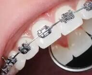 牙齿矫正要多久？不同牙套周期与效果解析