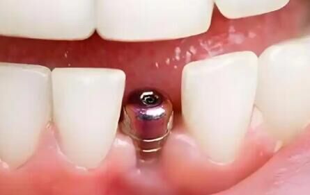 种植牙市场：2026年规模持续扩张，发展潜力无限