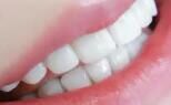氟斑牙、四环素牙，做贴面有用吗？