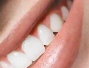 门牙做烤瓷牙还是全瓷牙更自然？