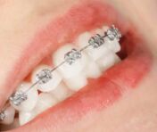 牙齿矫正会反弹吗？如何避免复发