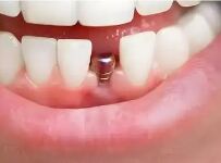 警惕低价陷阱：集采后种植牙避坑全指南