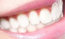 烤瓷牙术后护理：清洁、饮食与注意事项