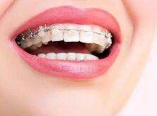 备孕妈妈必看：矫正牙齿会影响