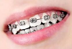 牙齿矫正流程全攻略（面诊到结