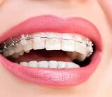 牙齿矫正后牙缝变大了正常吗？能恢复吗？