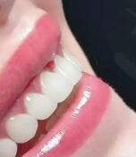 种植牙一定要选贵的吗？便宜的就不行？